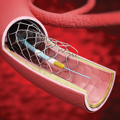 Vascular Surgery CME [2021] - CMEList